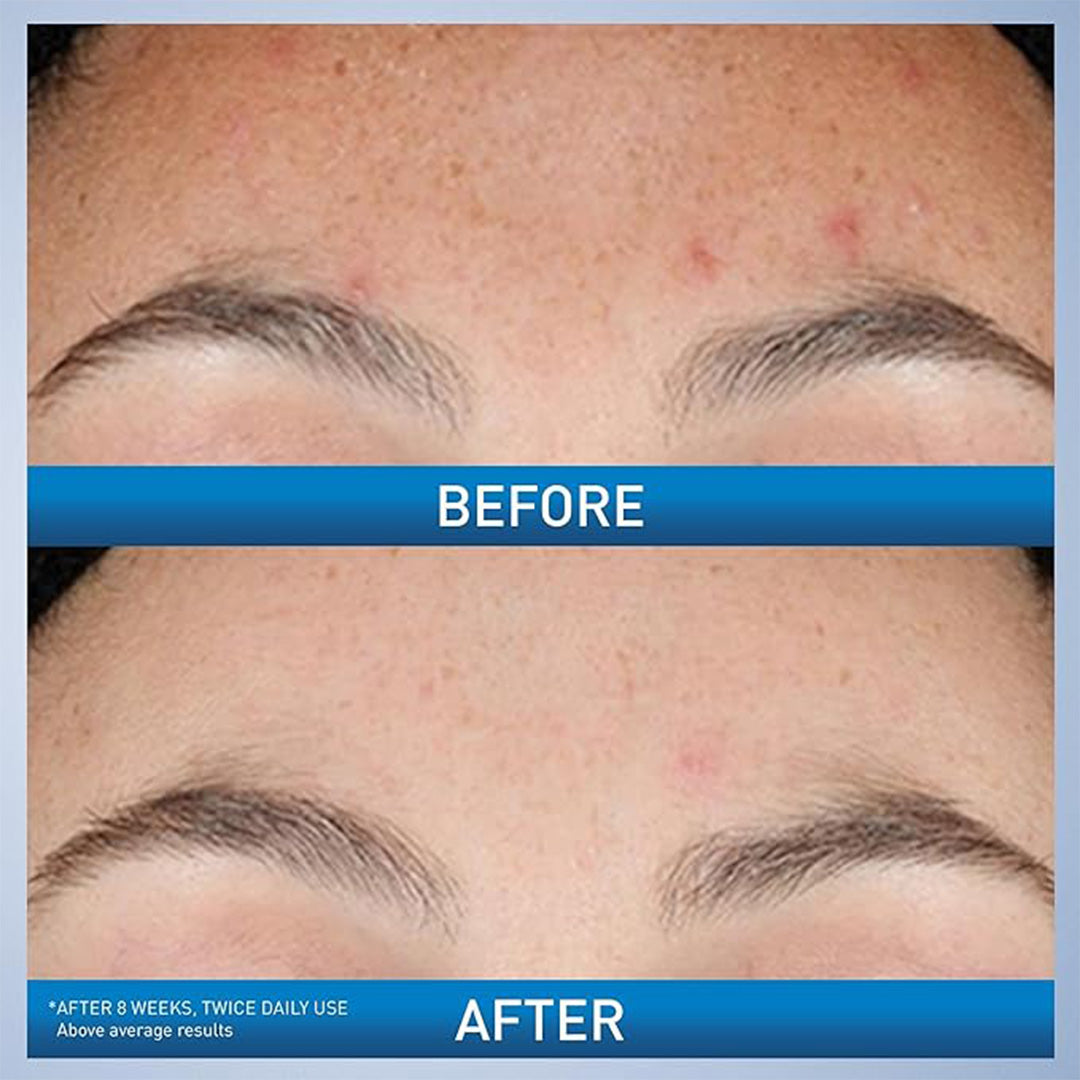 CeraVe Resurfacing Retinol Serum With Ceramides & Niacinamide For Blemish-Prone Skin 30 mL CeraVe