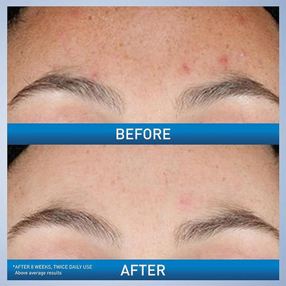 CeraVe Resurfacing Retinol Serum With Ceramides & Niacinamide For Blemish-Prone Skin 30 mL CeraVe
