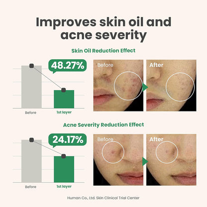 before and after comparision of reduction in skin oil and acne severity