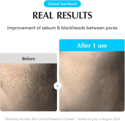 before and after results of sebum and blackheads improvement