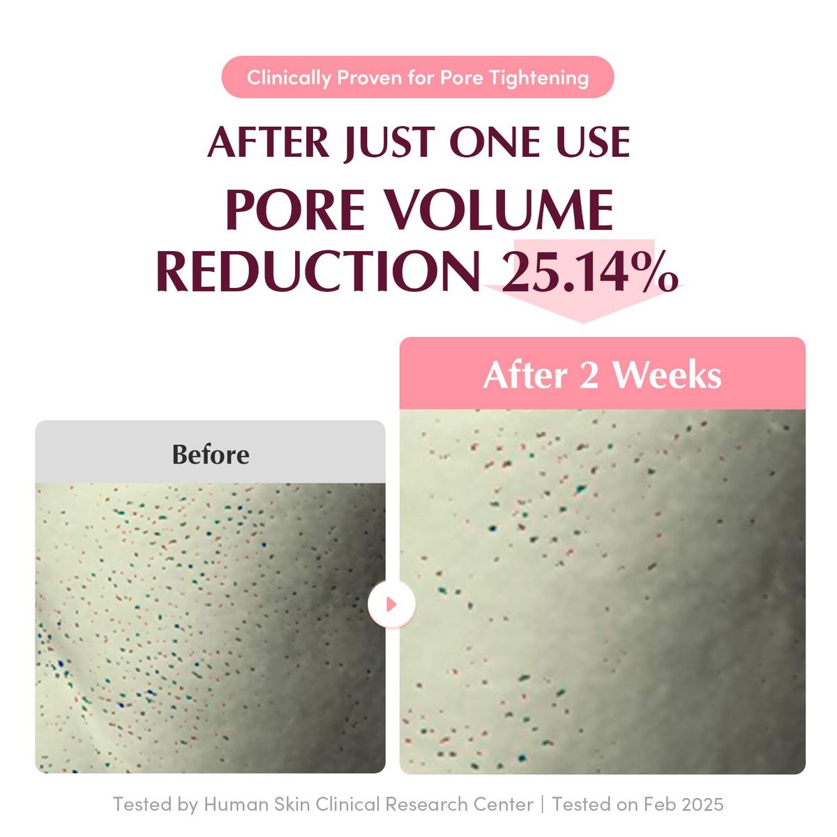 before and after comparision of pore volume reduction