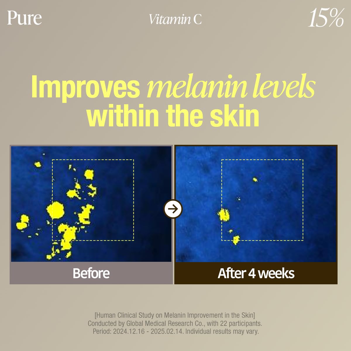 before and after comparison of melanin levels within the skin.