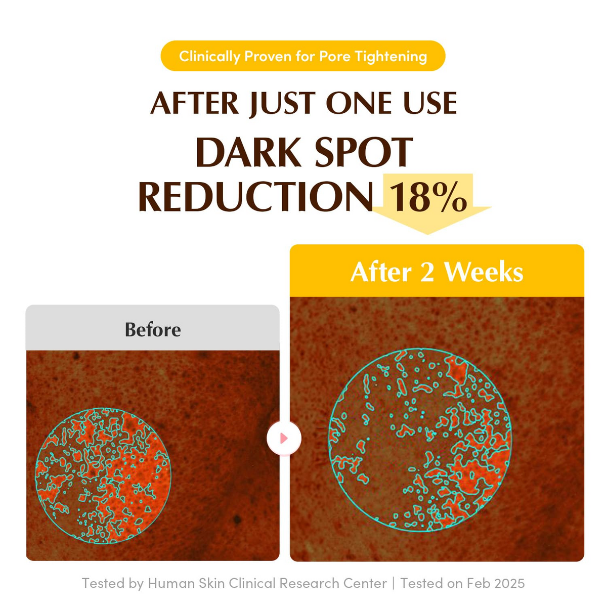 before and after comparision of dark spot reduction