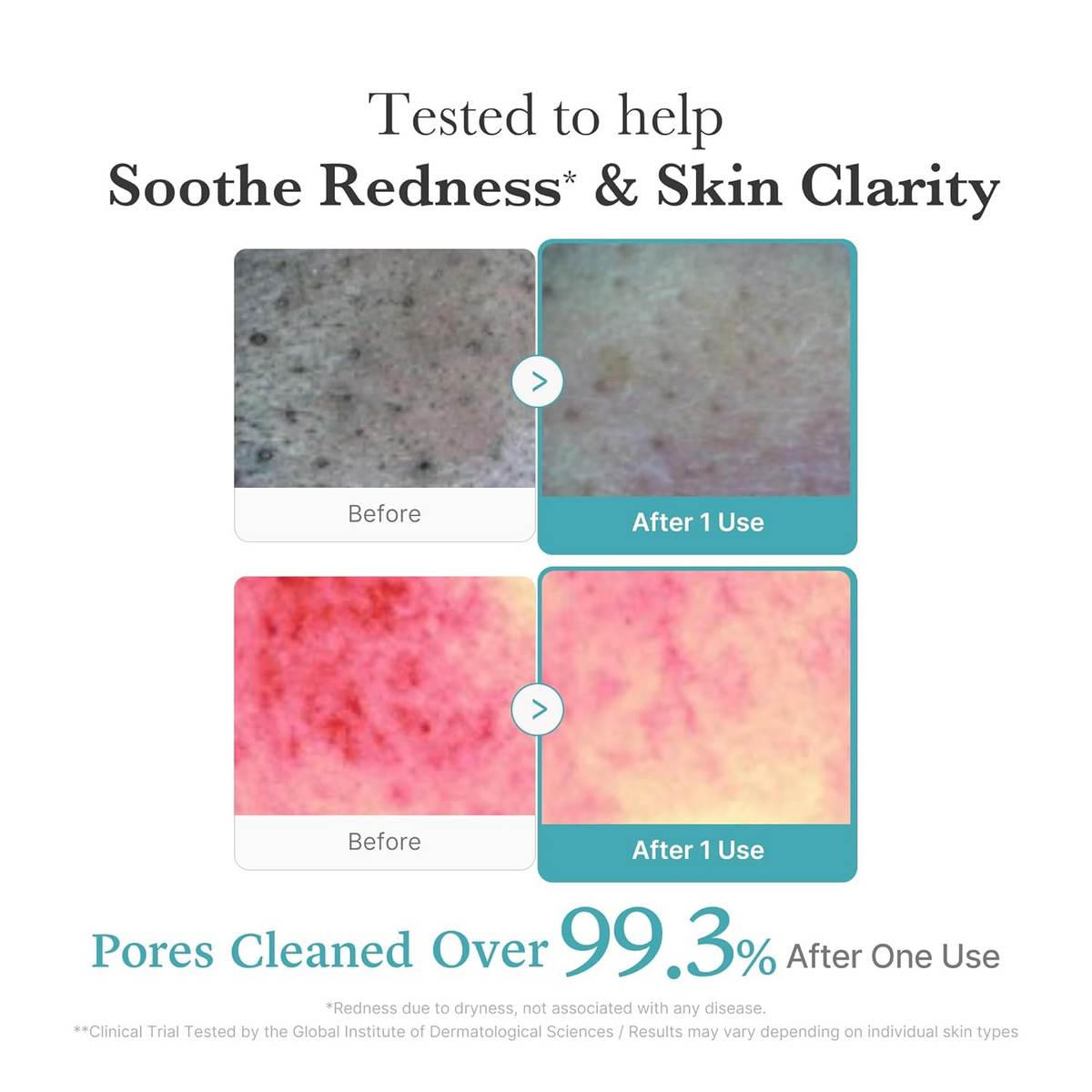 Before and after effects of a medicube Foam Cleanser  on skin clarity and redness.