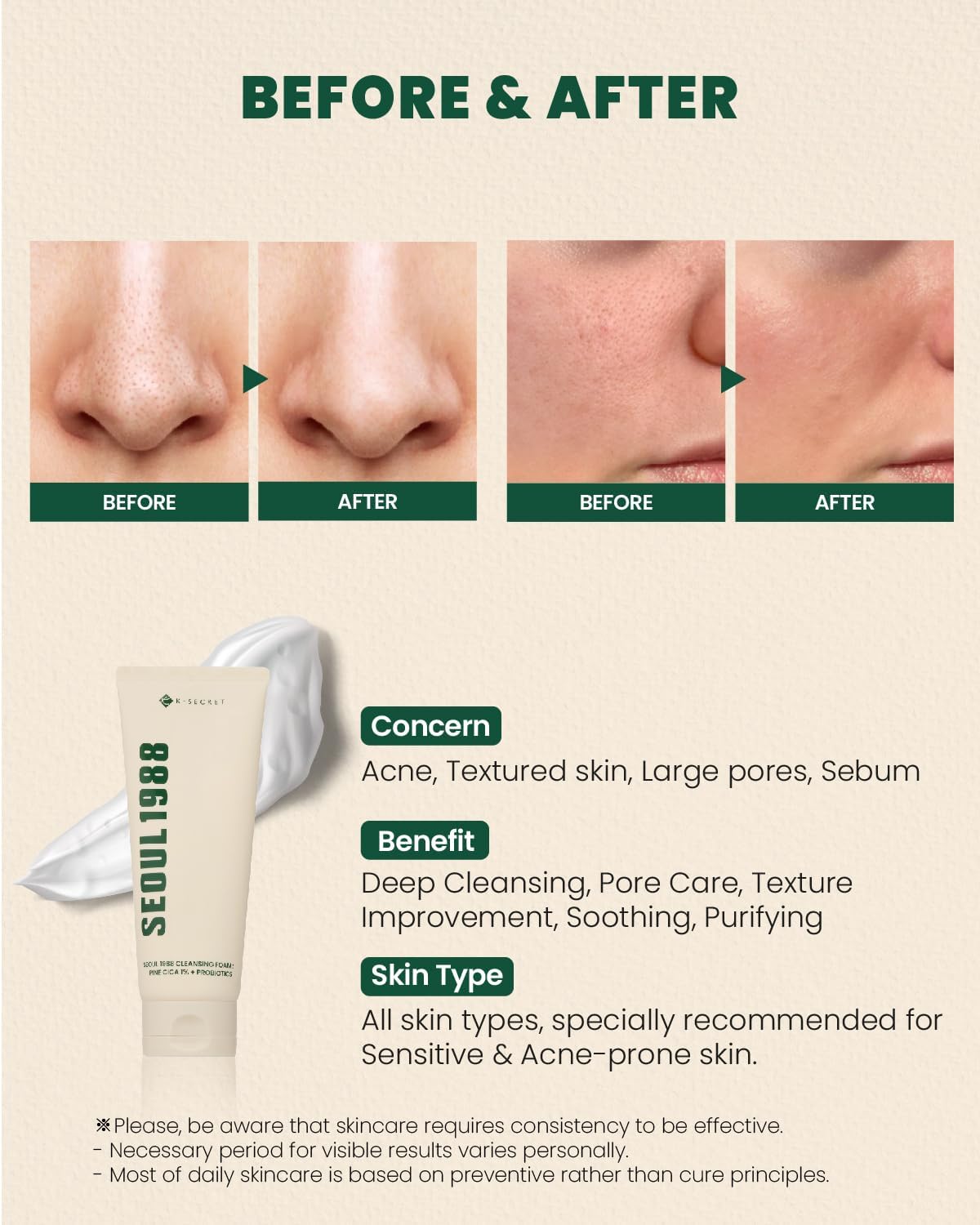 Seoul 1988 Cleansing Foam, Pine Cica 1% + Probiotics 150 ML
