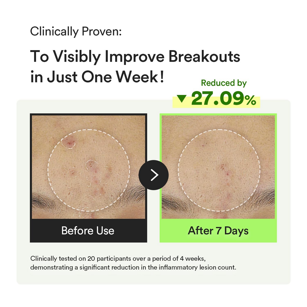 before and after comparision of skin with improved breakouts