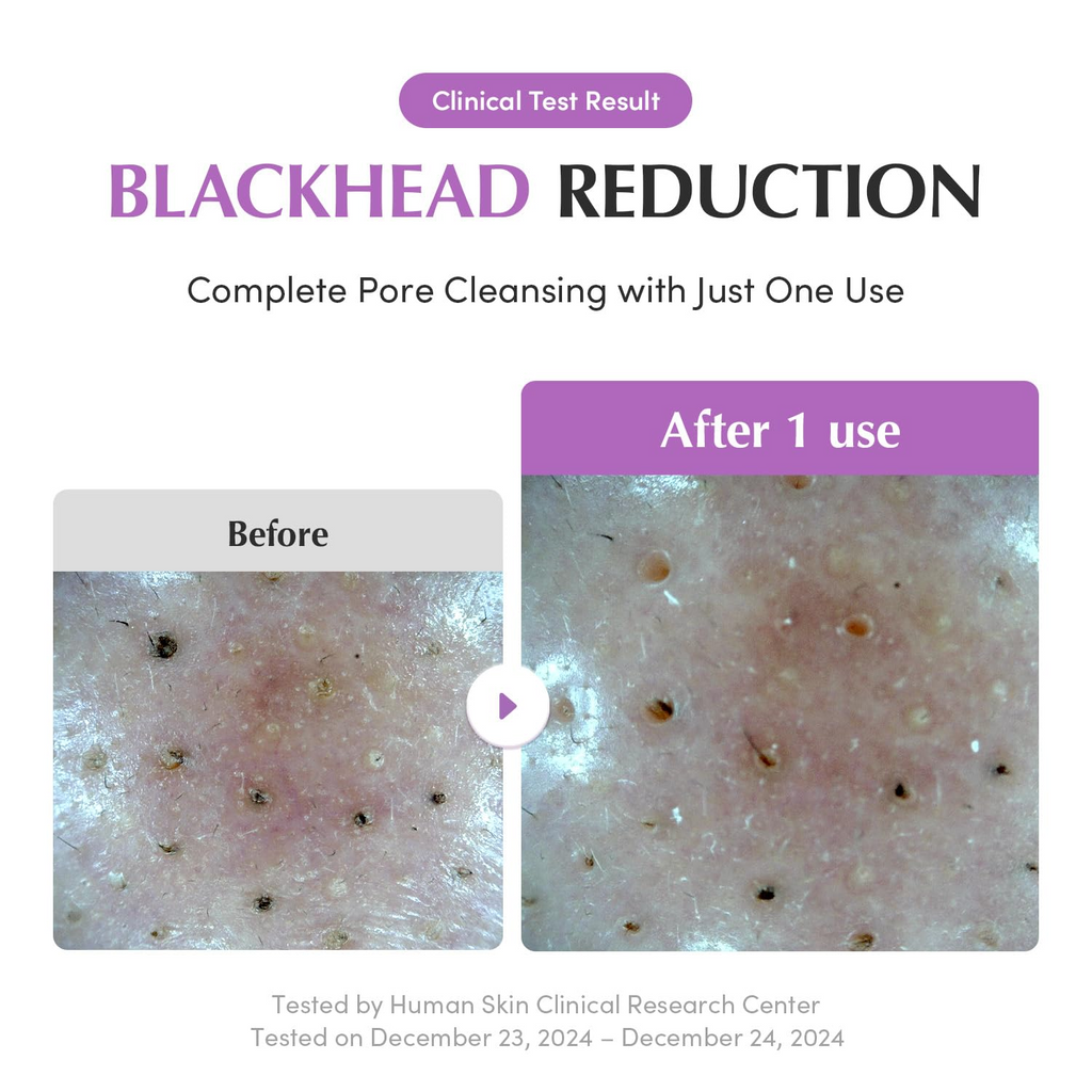 before and after comparision of blackhead reduction 