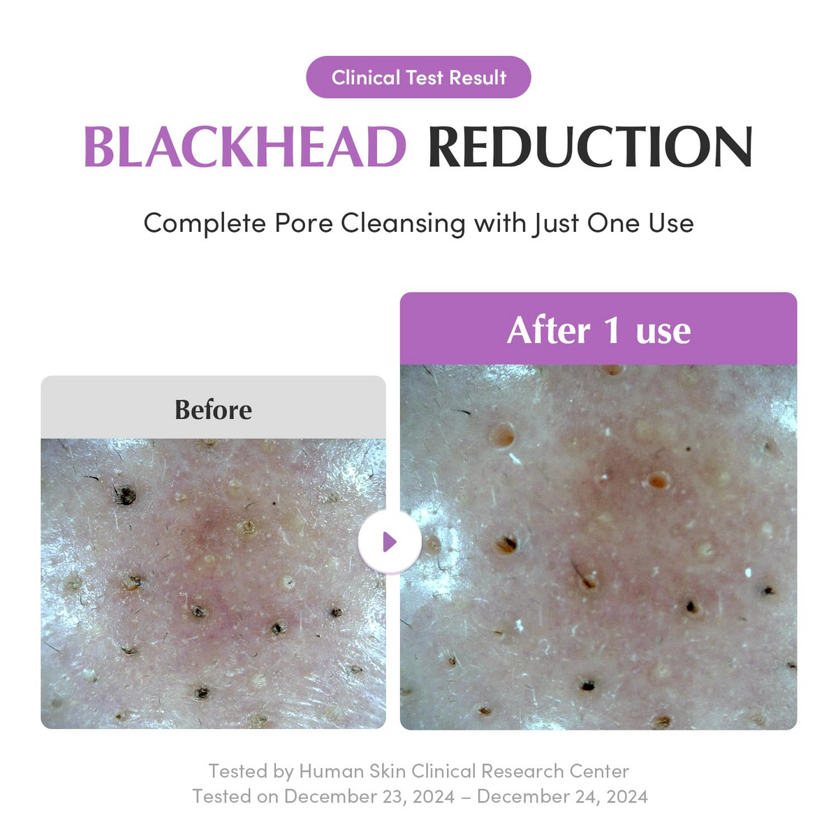 before and after comparision of blackhead reduction 