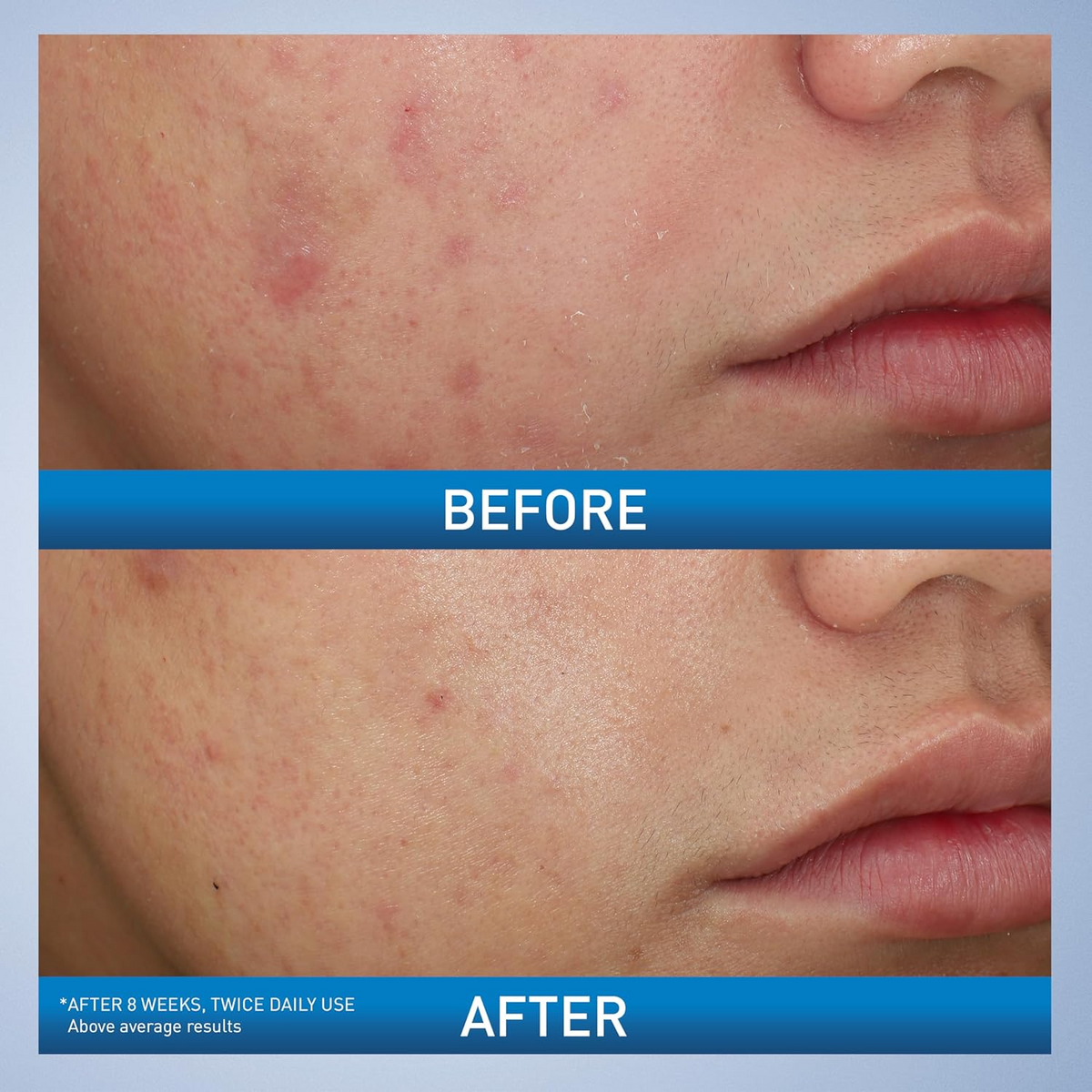 two images of before and after comparision of skin after treatment