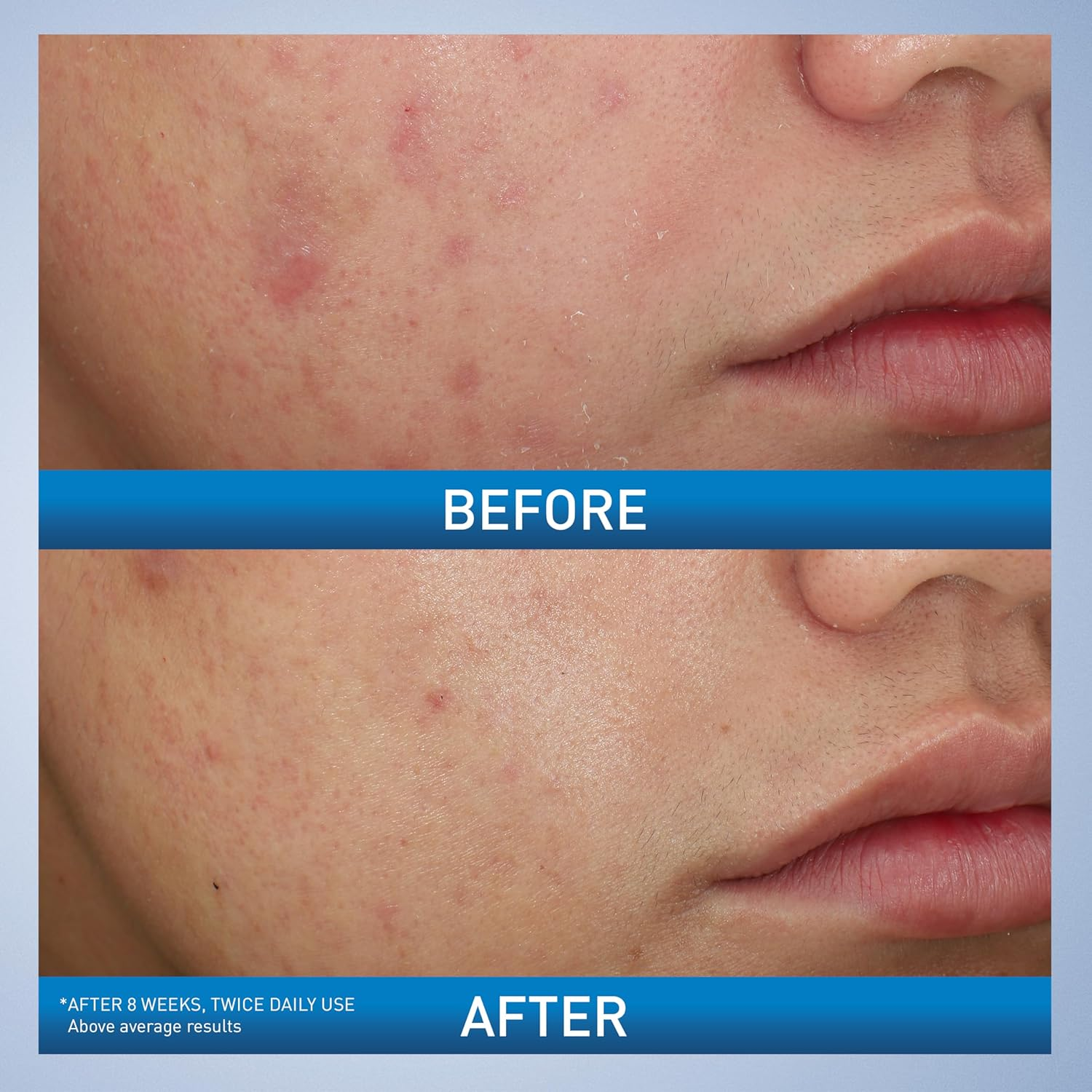 two images of before and after comparision of skin after treatment