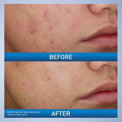 two images of before and after comparision of skin after treatment
