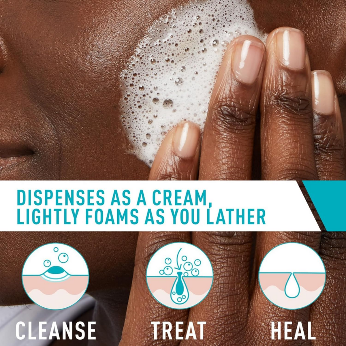 CeraVe Acne Foaming Cream Cleanser applied on cheek 