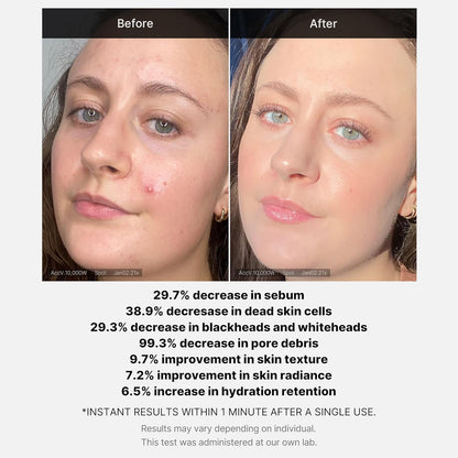 medicube Red Acne Succinic Acid Peel 40g (1.41 oz) MediCube
